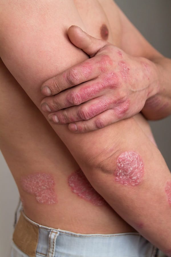 Psoriasis Causes SaiAyush Ayurveda Hospital Hyderabad