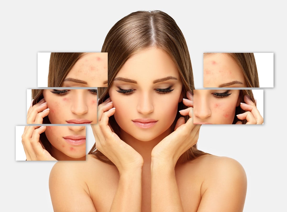 Treatment of Acne SaiAyush Ayurveda Hospital Hyderabad