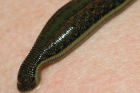 ayurveda raktamokshana veins treatment