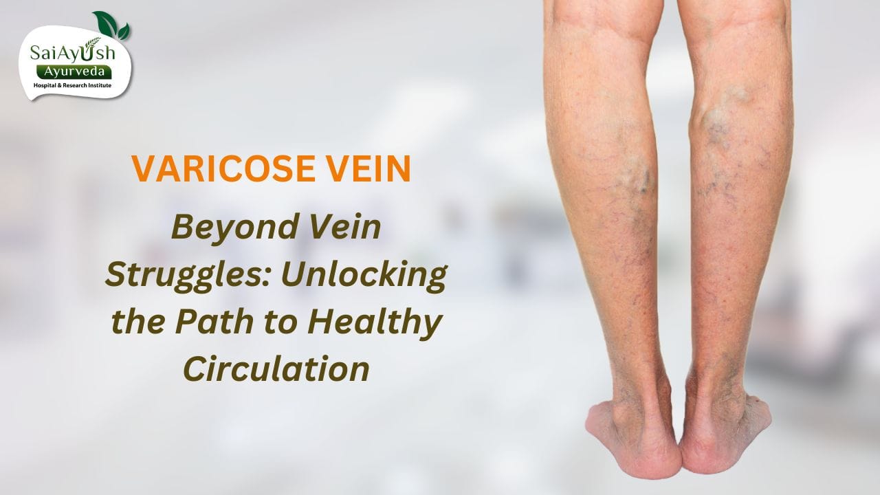 varicose vein