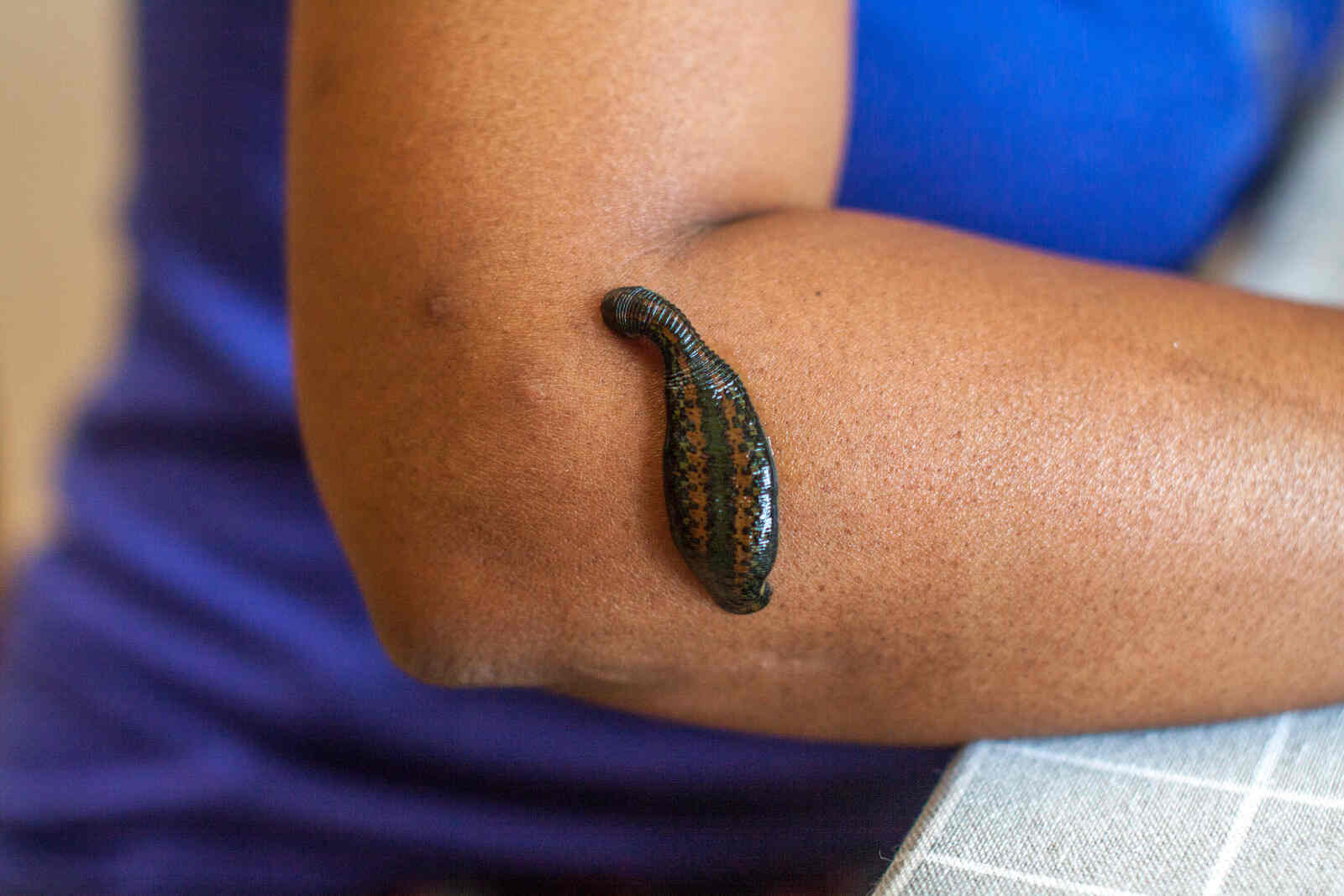 Raktha Mokshana Ayurvedic Therapy