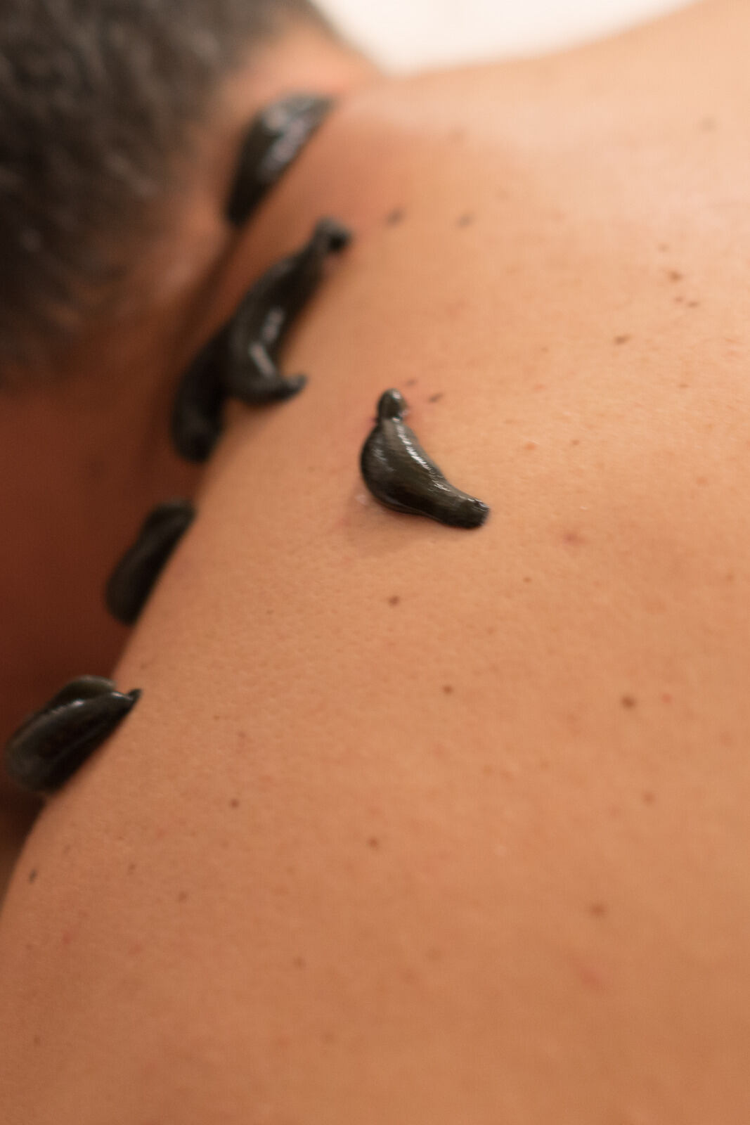 Raktha Mokshana Therapy