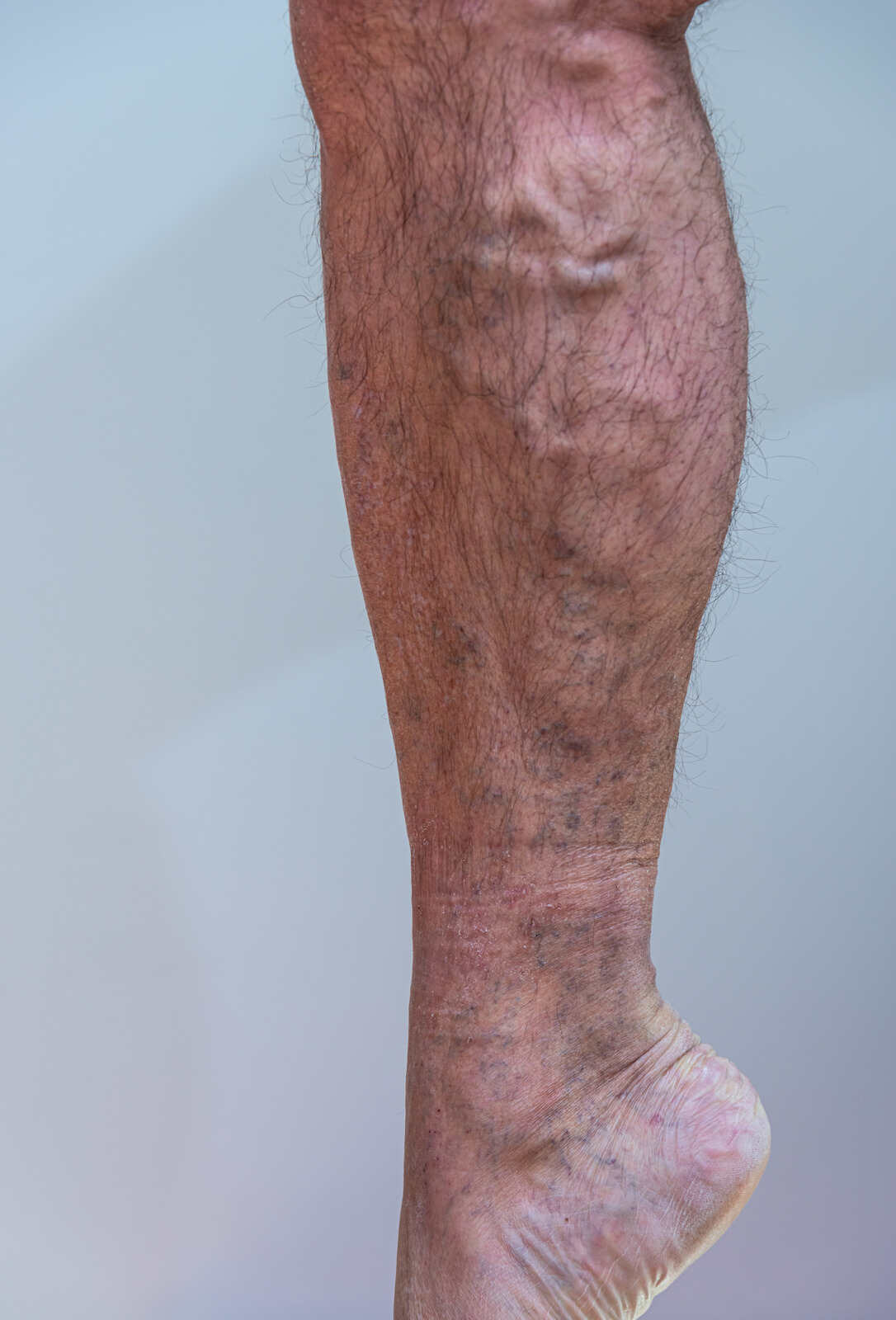 Varicose Veins1