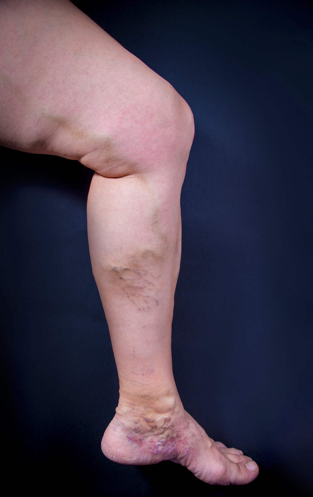 Varicose Veins2